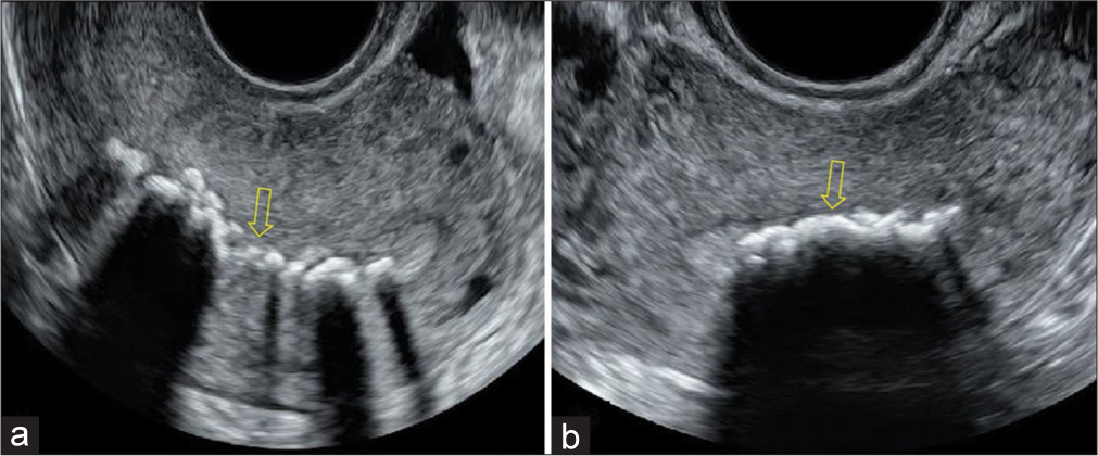 Bone within the endometrium: An uncommon cause of secondary infertility