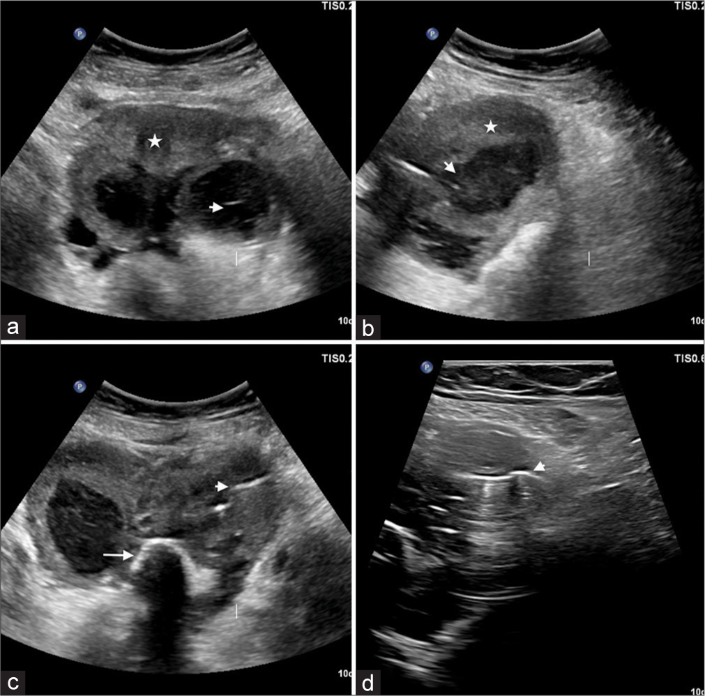 Diagnostic dilemma – Ovarian dermoid cysts presenting with uncommon complications and a rare association
