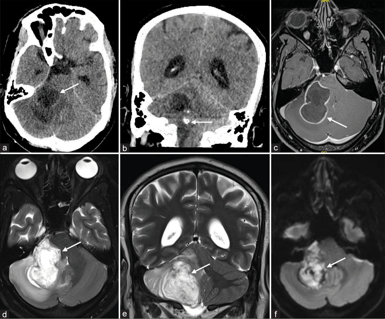 Neurobrucellosis presenting as an infected epidermoid cyst in the cerebellum – A case report