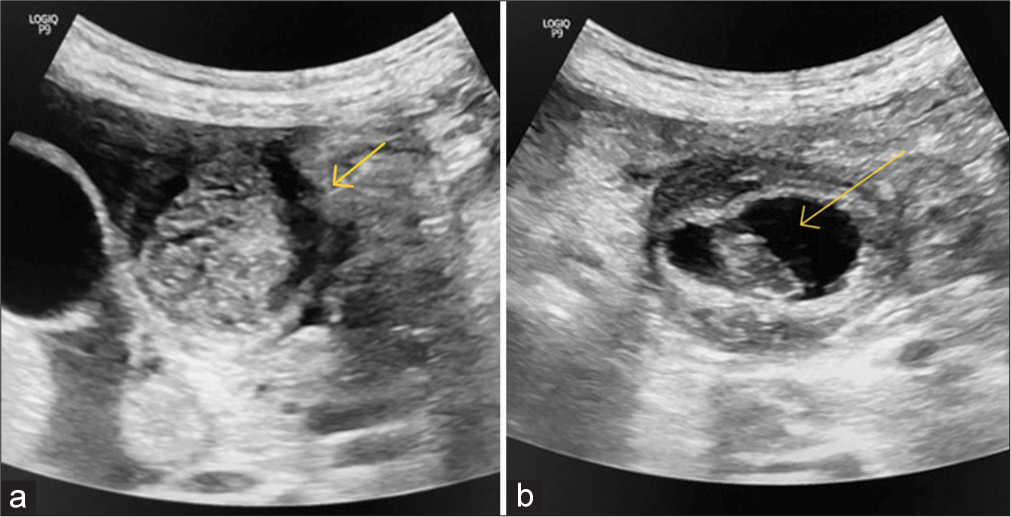 An extremely rare culprit for a common crime: A case report on gastric duplication cyst associated with accessory pancreatic lobe