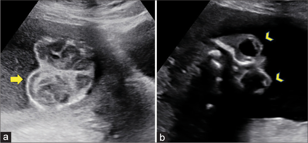 Unraveling the mystery of a rare neural tube defect: Antenatal sonographic diagnosis with a brief literature review