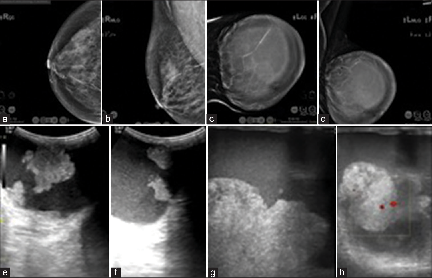 Rare benign breast neoplasm masquerading as malignancy on anatomical and functional imaging with contrast-enhanced mammography