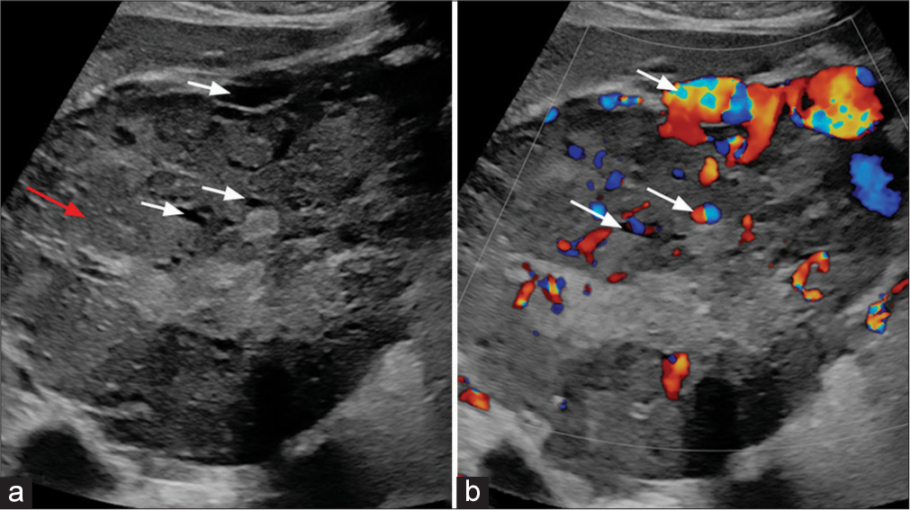 Exploring the enigmatic giant liver lesion