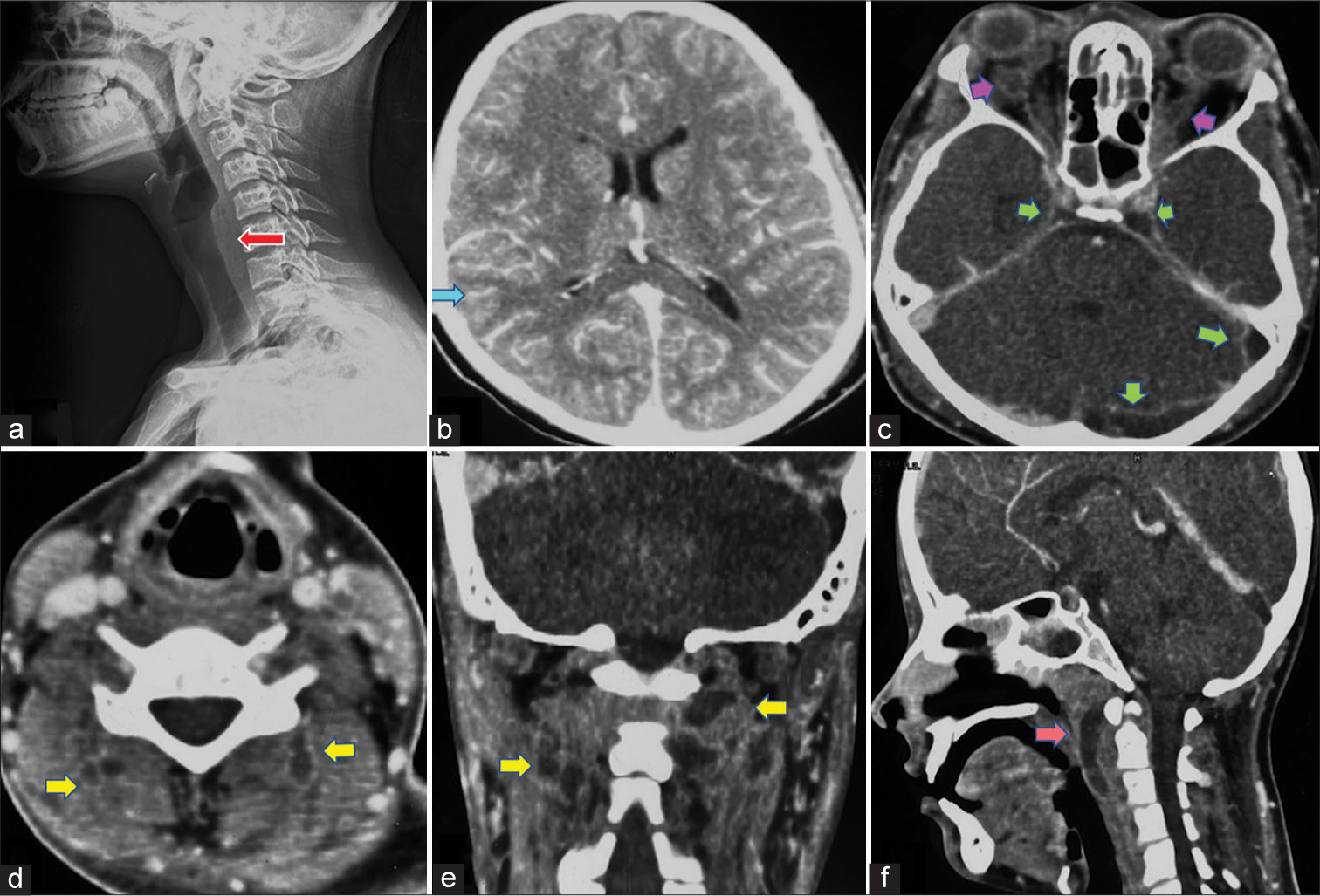 Twists and turns: Unraveling unusual cervical instability in a case of prior neck infection