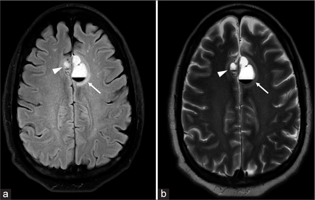 Cystic hemorrhagic intracranial metastasis in prostatic carcinoma