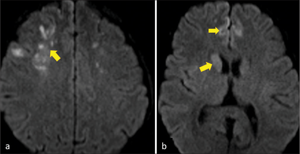 Pathological laughter as an initial presentation of bilateral internal carotid artery agenesis