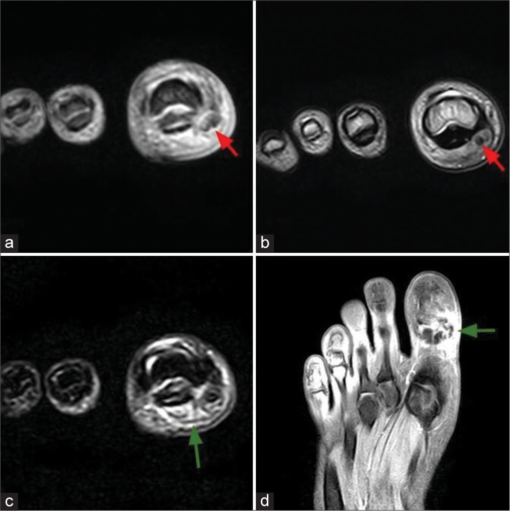 Cracking the calcium code: Diagnosing hydroxyapatite deposition disease