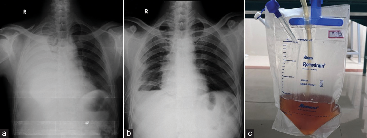 From pancreas to pleura: Unraveling a rare complication