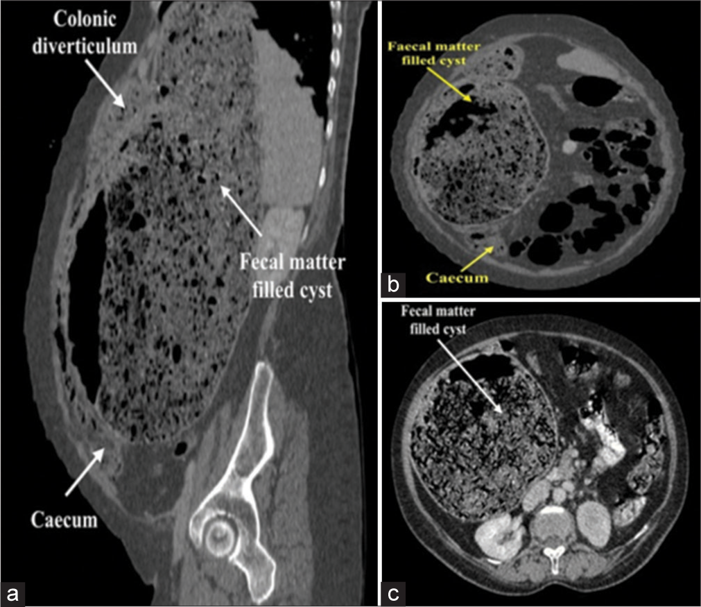 Cecal duplication cyst in an adult: A case report