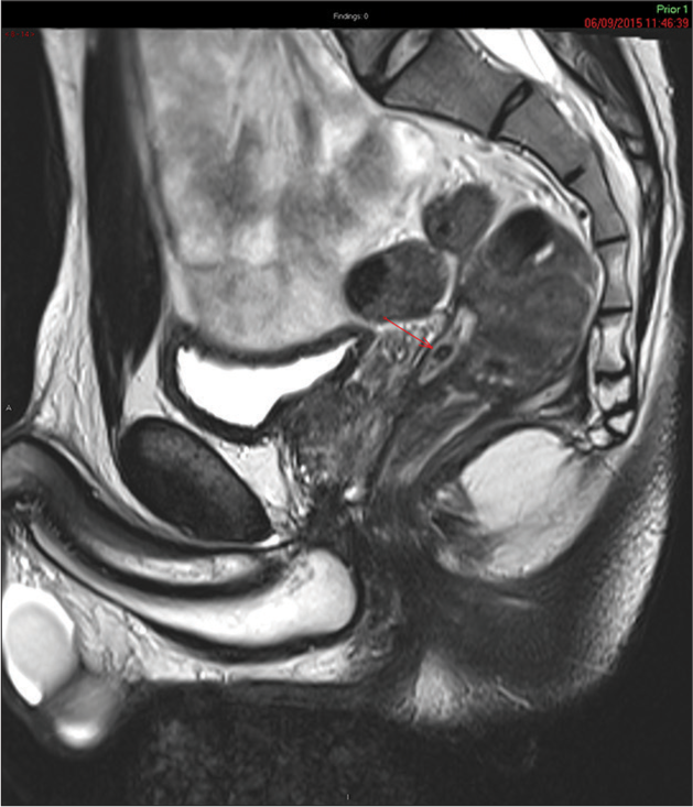 Perineal fistulation secondary to retained appendicolith: A rare complication of the unaccounted calculus