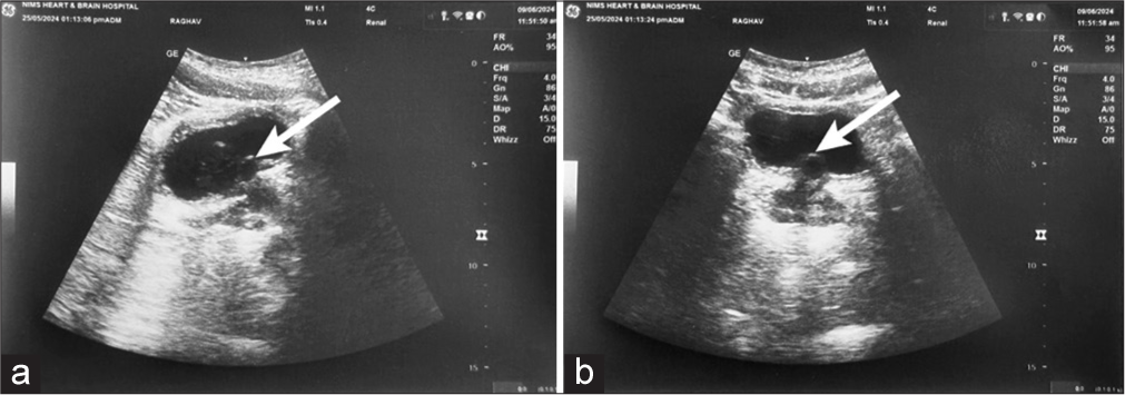 Brunn’s cyst presenting as a rare cause of lower urinary tract symptoms – A case report