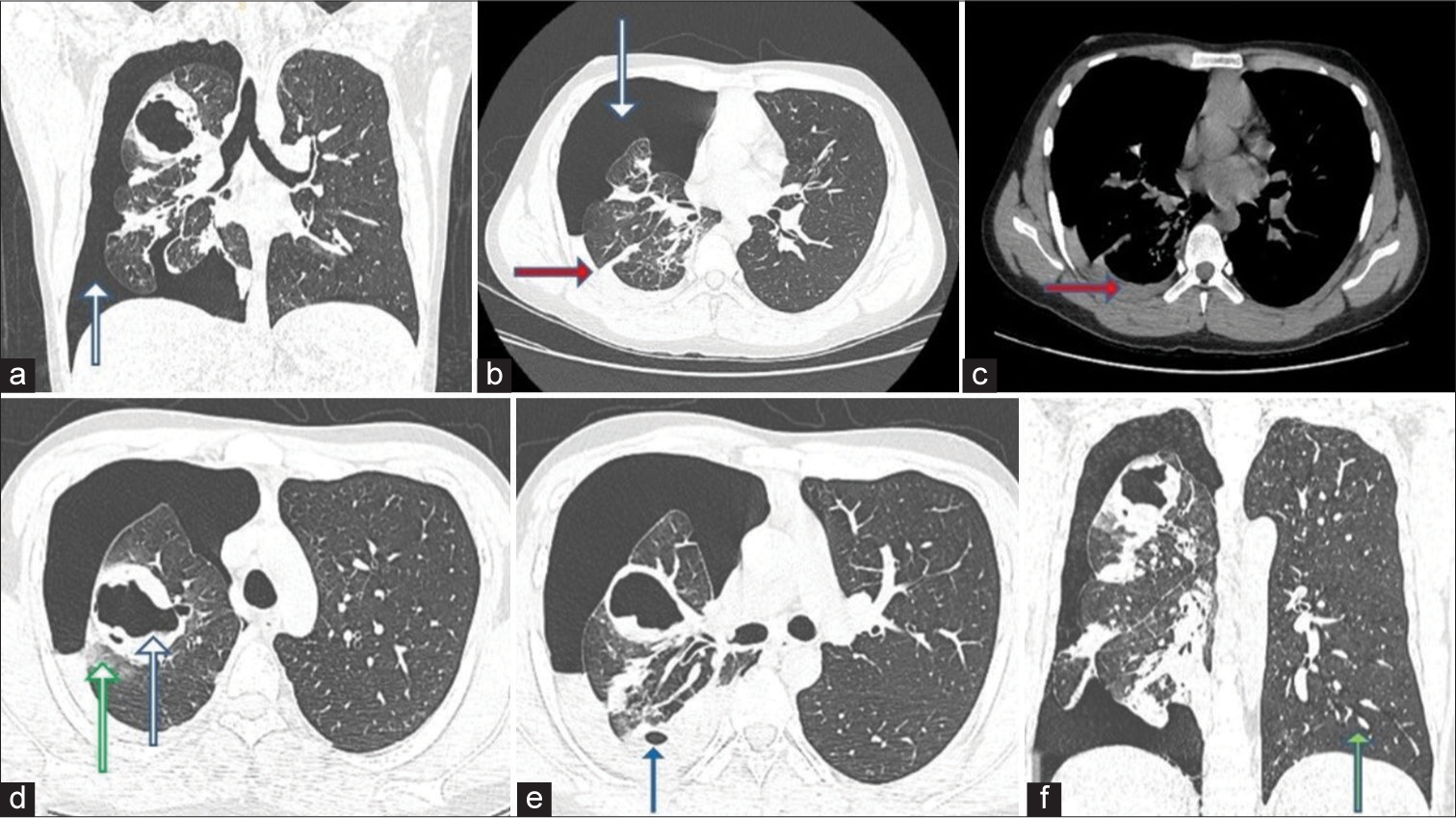 A bizarre case of recurrent hemoptysis and pneumothorax in a young male