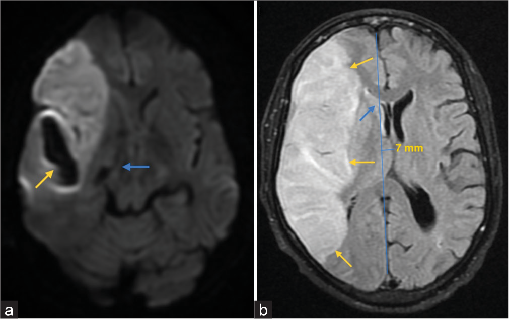 Sinking skin flap syndrome: A rare complication following a craniectomy