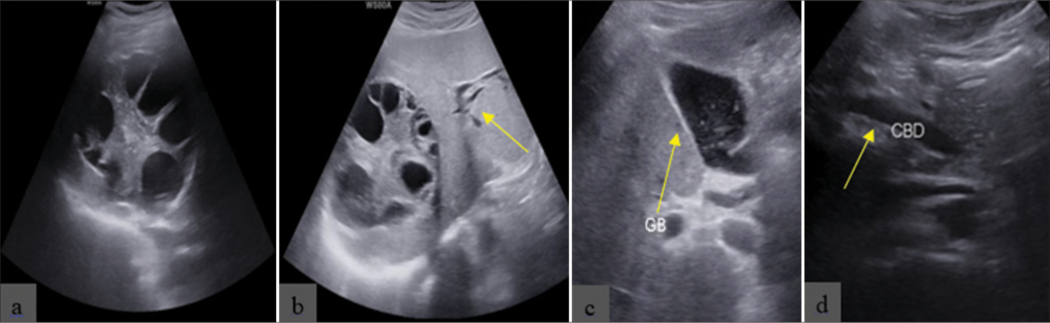 A rare case of hepatic hydatid cyst with cystobiliary communication causing obstructive jaundice