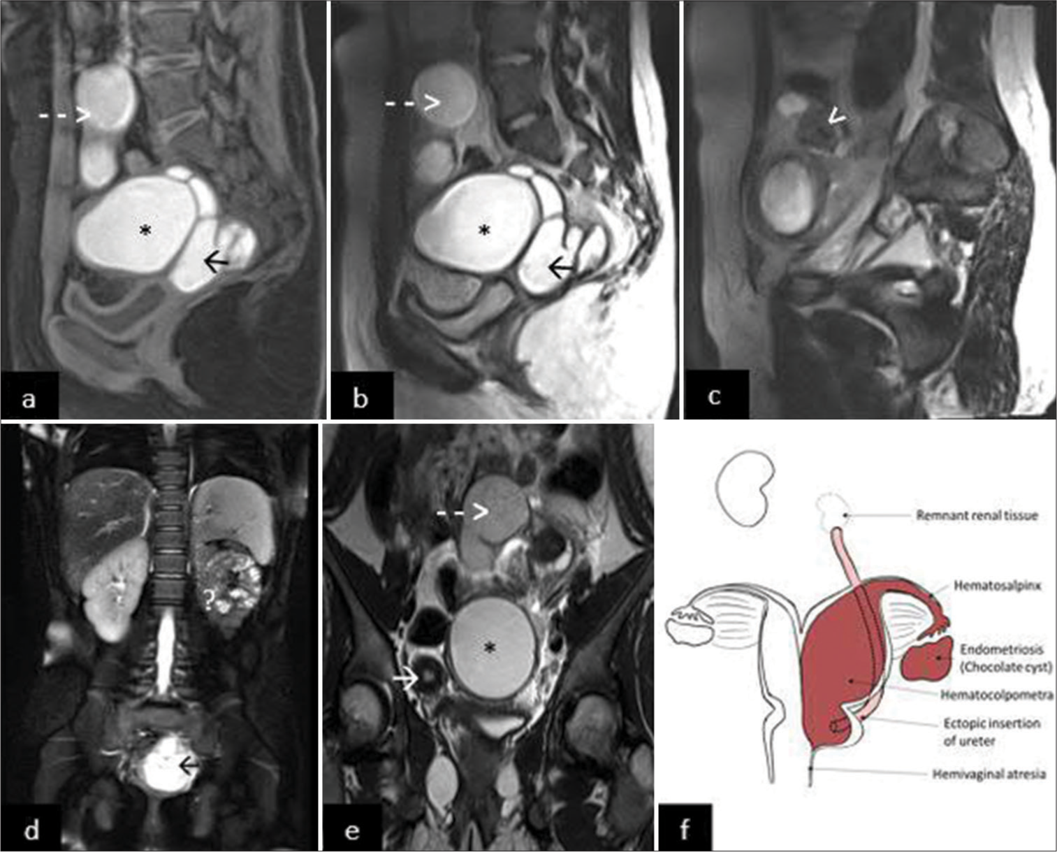 Blind ectopic hemato-megaureter: A rare association with the rare obstructed hemivagina and ipsilateral renal agenesis (OHVIRA) syndrome