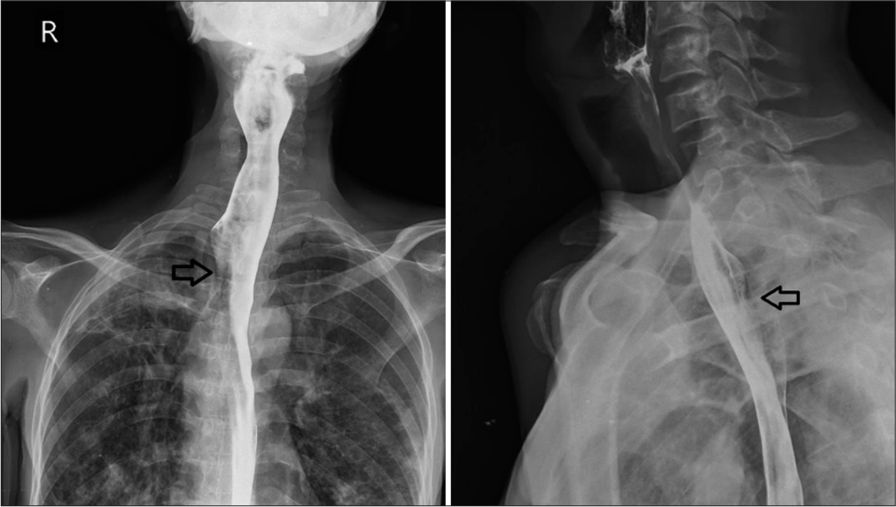 A rare cause of esophageal dysphagia due to dilatation of azygos vein