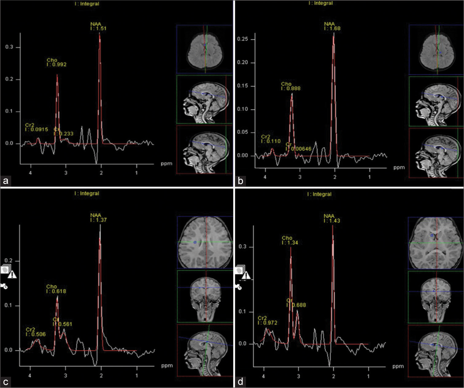 Magnetic resonance spectroscopy as a diagnostic tool in cerebral creatine deficiency syndrome 3