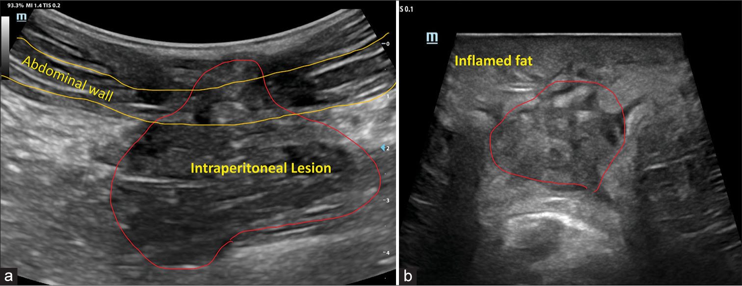 Paradox of aggressive benignity in abdominal wall