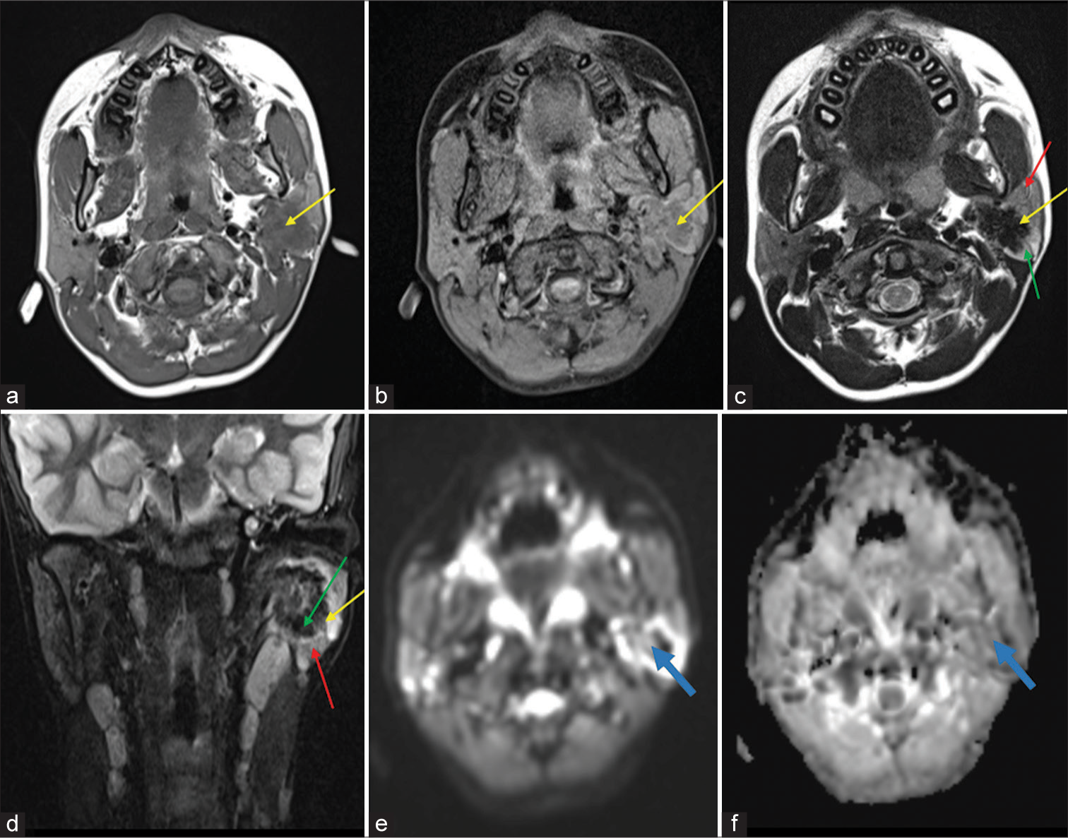 Chronic sclerosing sialadenitis of the parotid gland mimicking a neoplasm