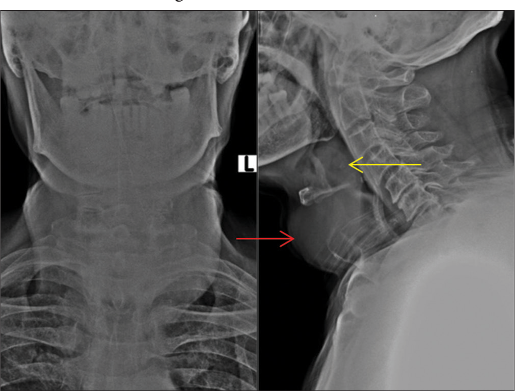 Thyroglossal cyst with intralaryngeal extension – An unusual case report