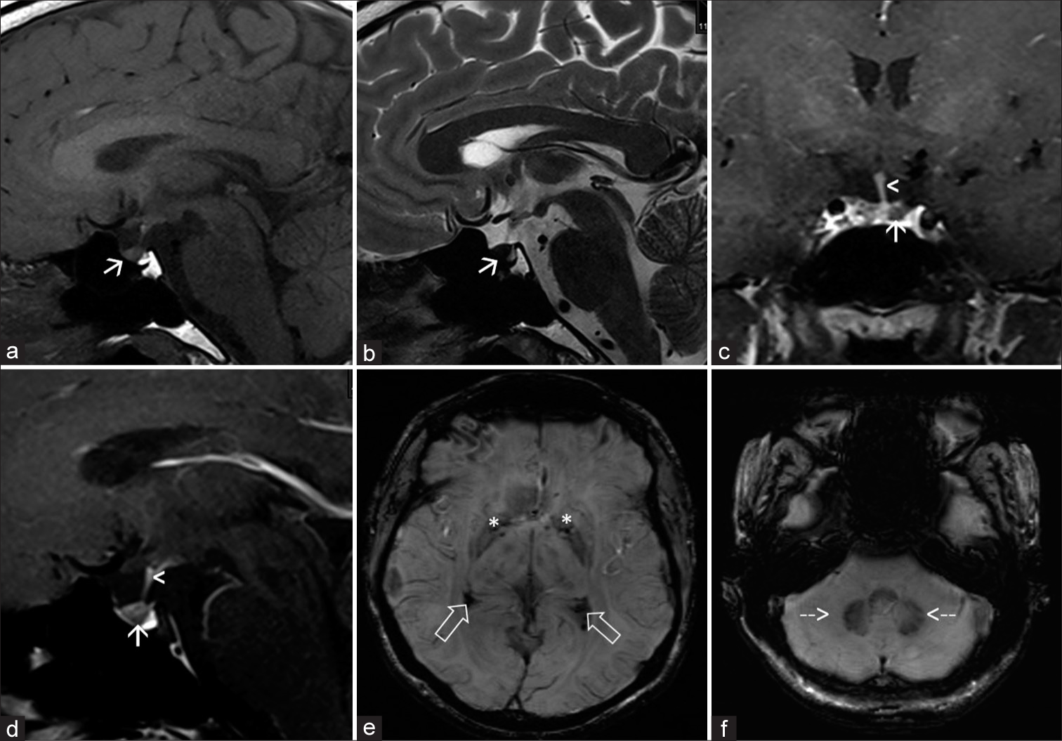 Pituitary hypointensity: Hemochromatosis as an overlooked cause of hypogonadotropic hypogonadism