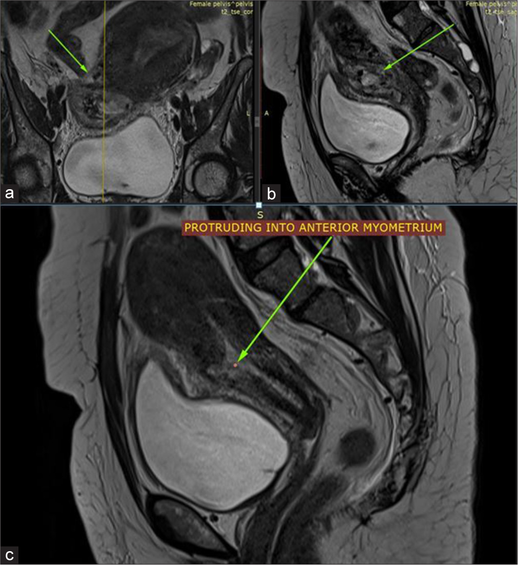 Beyond the missed abortion: Uncovering the threat of scar ectopic in routine scan for RPOC