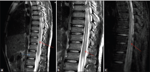 A rare case of paralytic rabies presented with acute flaccid transverse myelitis in case of inadequate post-exposure prophylaxis