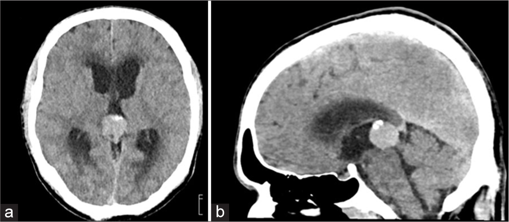 Unusual pineal gland lesion presenting with obstructive hydrocephalus: A multimodal imaging perspective