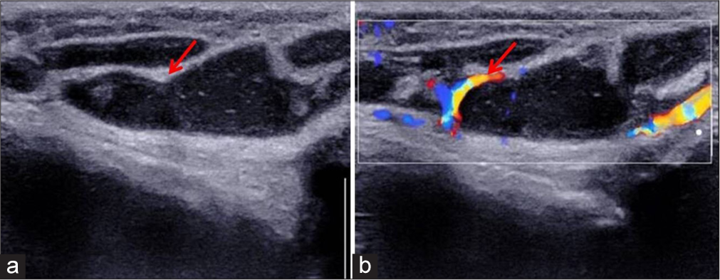 Decoding chronic subcutaneous mysteries