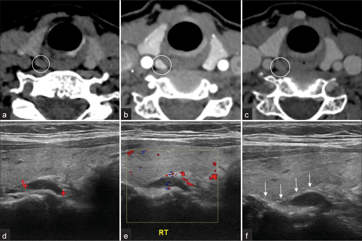 Adding the fourth dimension to computed tomography neck in the evaluation of parathyroid adenoma