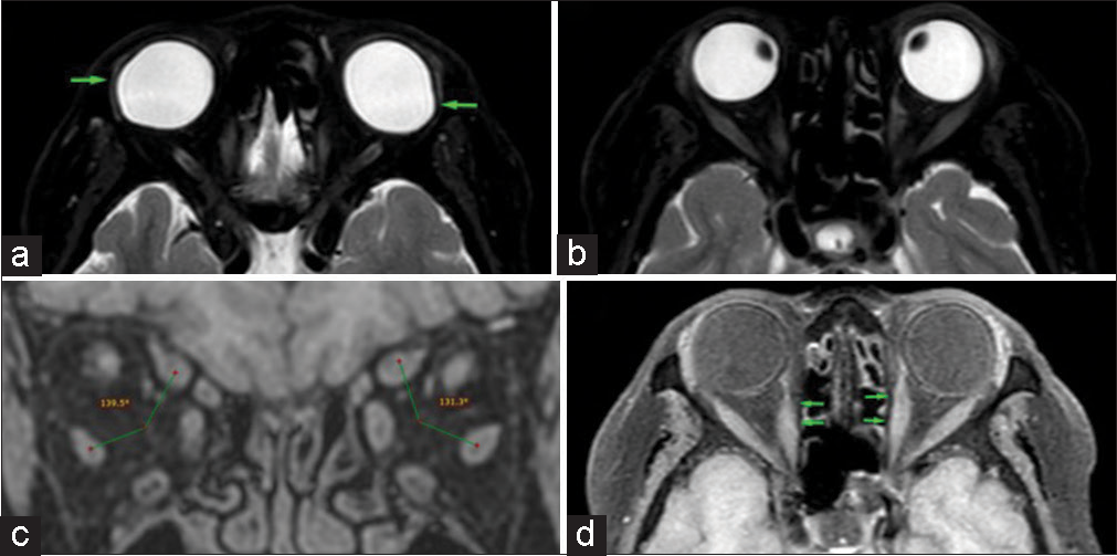 Heavy eye syndrome as a cause of recurrent strabismus