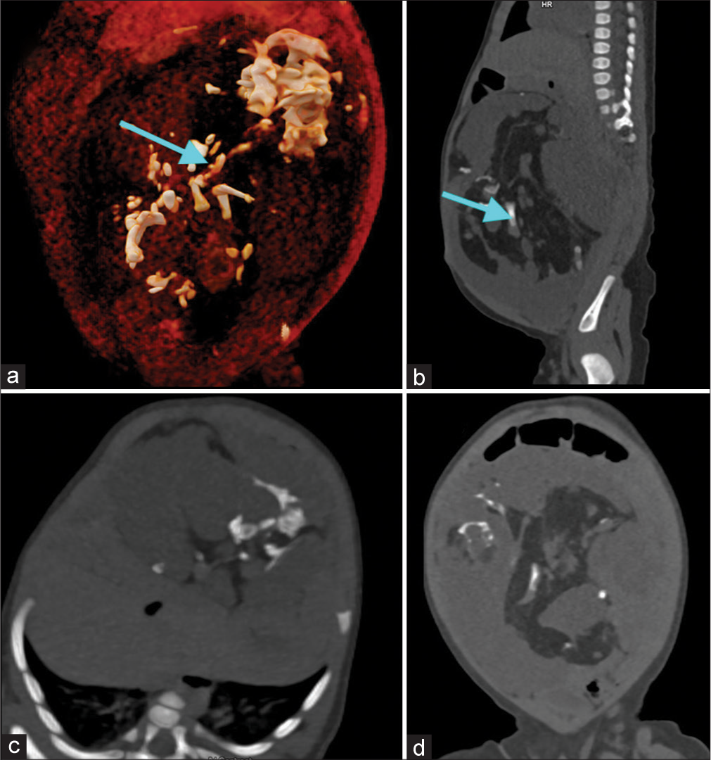 Retroperitoneal homunculus lesion in a newborn male