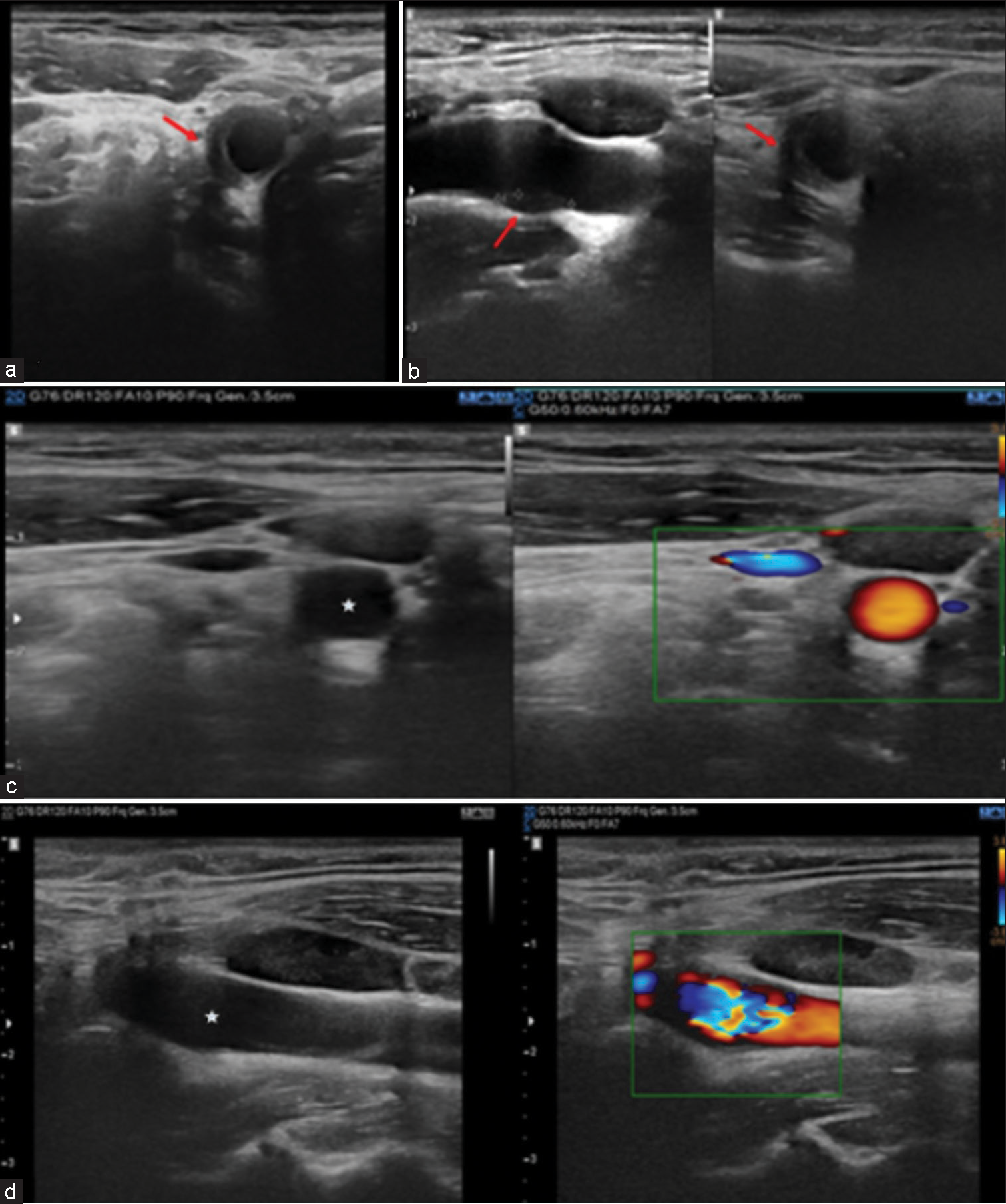 TIPIC-al neck pain?