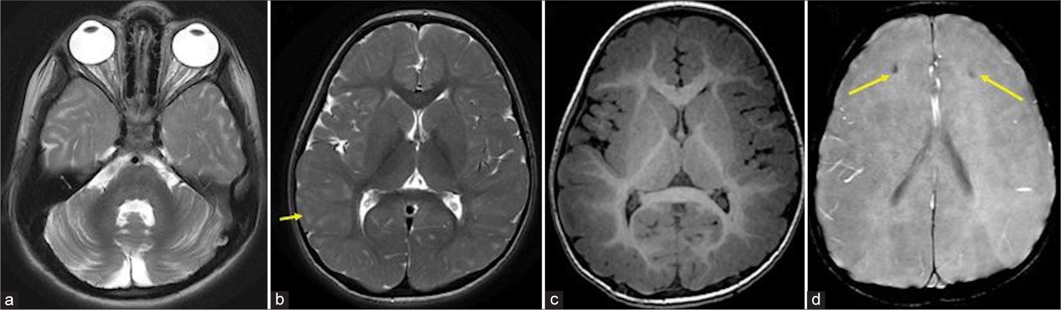 Classical imaging in cerebral folate transport deficiency