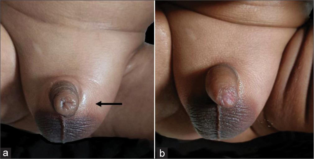 Infantile inguinal hernia complicated with ileoileal intussusception