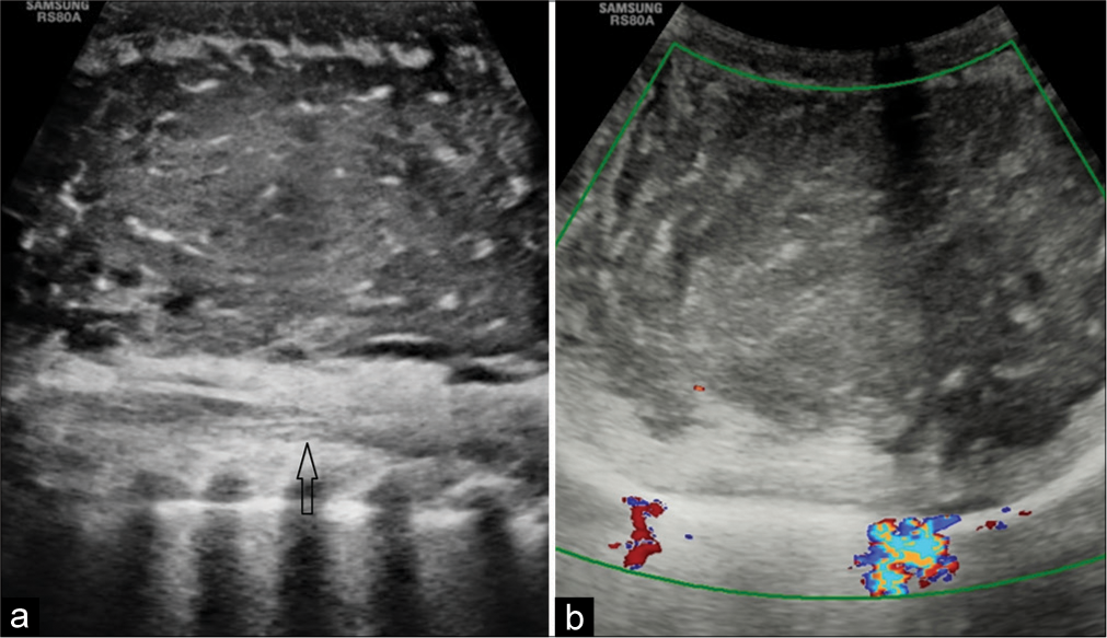 Role of imaging in atypical infantile lipofibromatosis