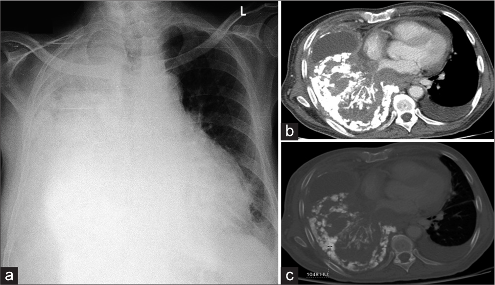 Primary pulmonary osteosarcoma: A rare malignancy of the lung with histopathologic correlation