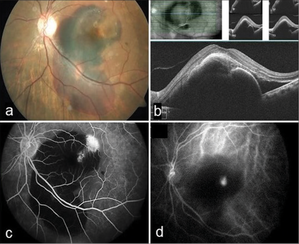 Managing massive submacular hemorrhage using intravitreal brolucizumab in combination with subretinal tissue plasminogen activator and non-expansile gas – A case report