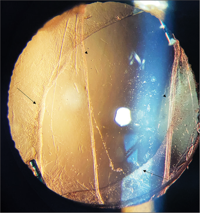 Optic capture of the intraocular lens in posterior capsular rupture