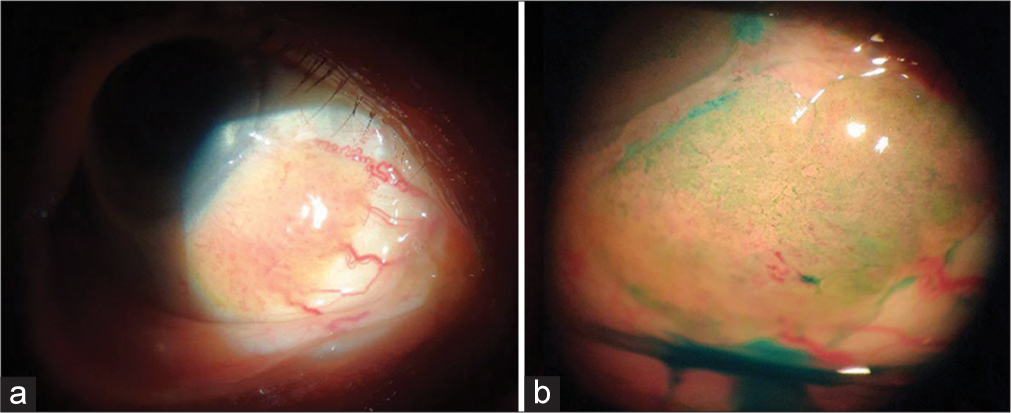 Topical 5-fluorouracil as monotherapy for ocular surface squamous neoplasia