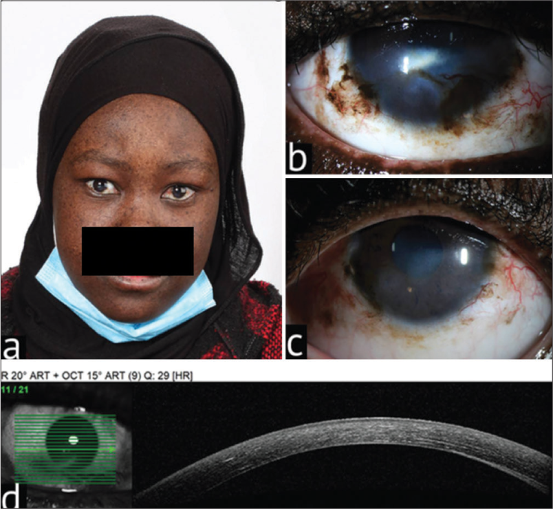 Corneal manifestations of xeroderma pigmentosa in a heavily pigmented patient