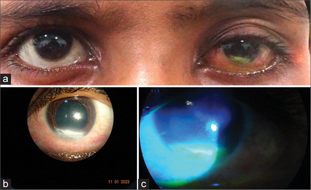 Suspected corneal metastasis in a case of nasopharyngeal carcinoma