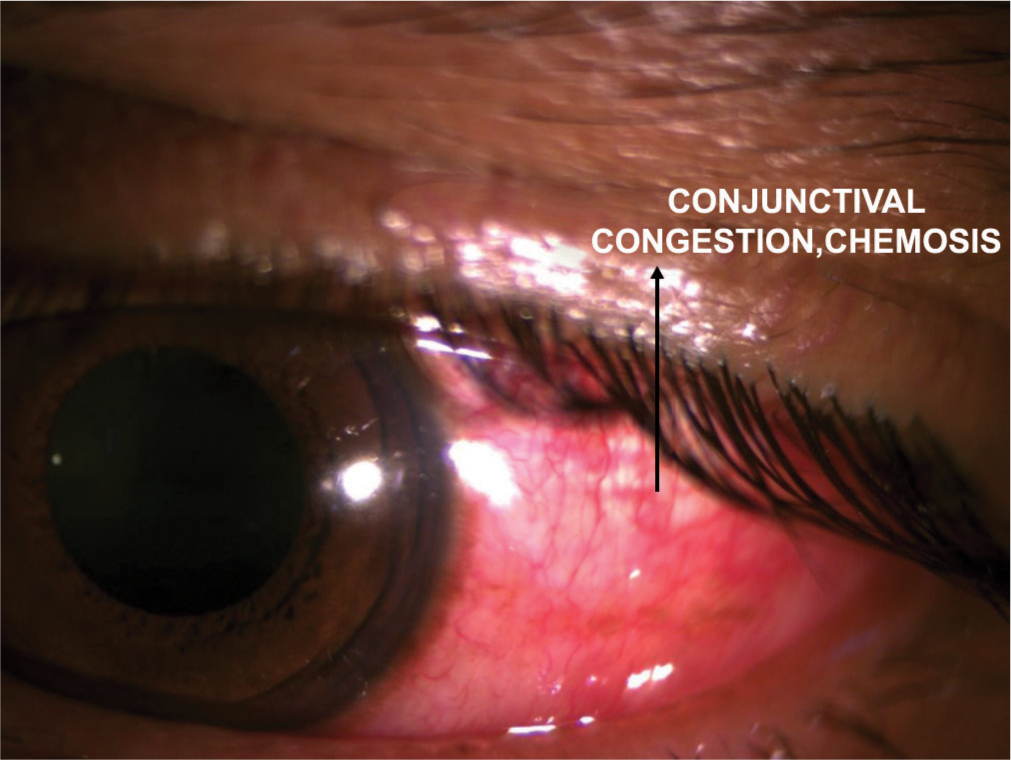 Topiramate: Connecting dot of acute angle closure with myopic shift and missing link with acute anterior uveitis