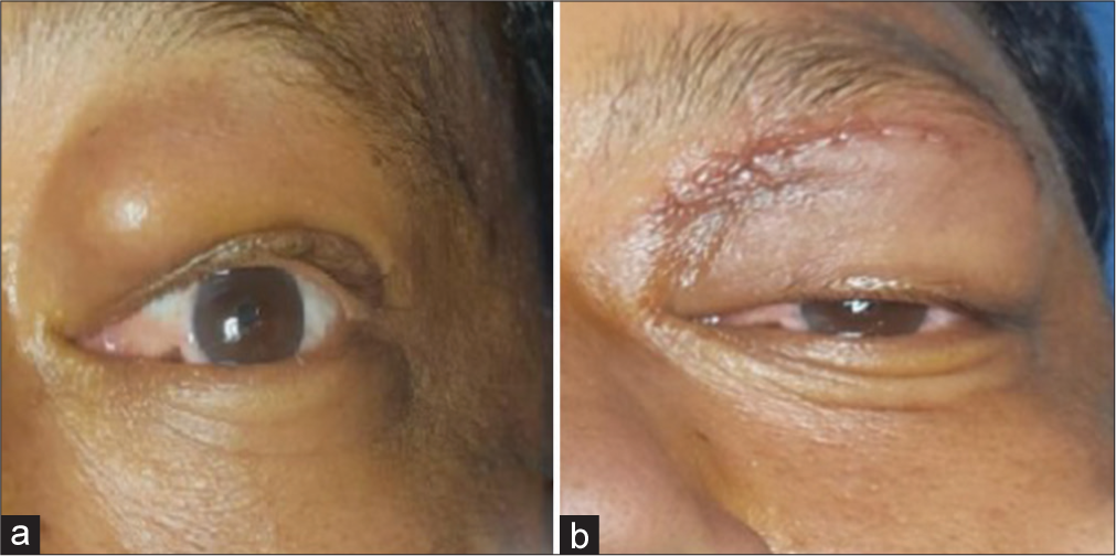 Peripheral giant cell granuloma of orbit: A case report