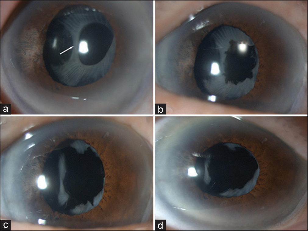 An unusual configuration of anterior capsular phimosis in an elderly asian patient