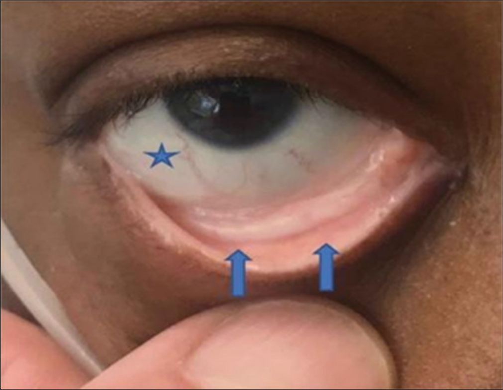 Anemic retinopathy in a patient with abdominal tuberculosis: A case report
