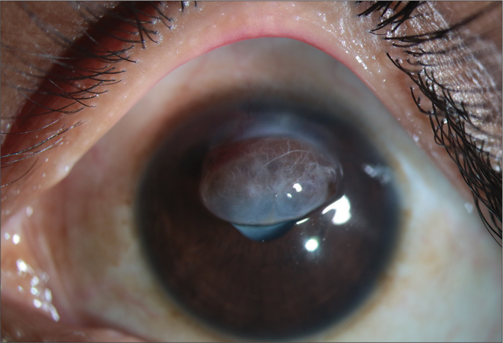Tenons patch graft in management of old corneal tear – A case report