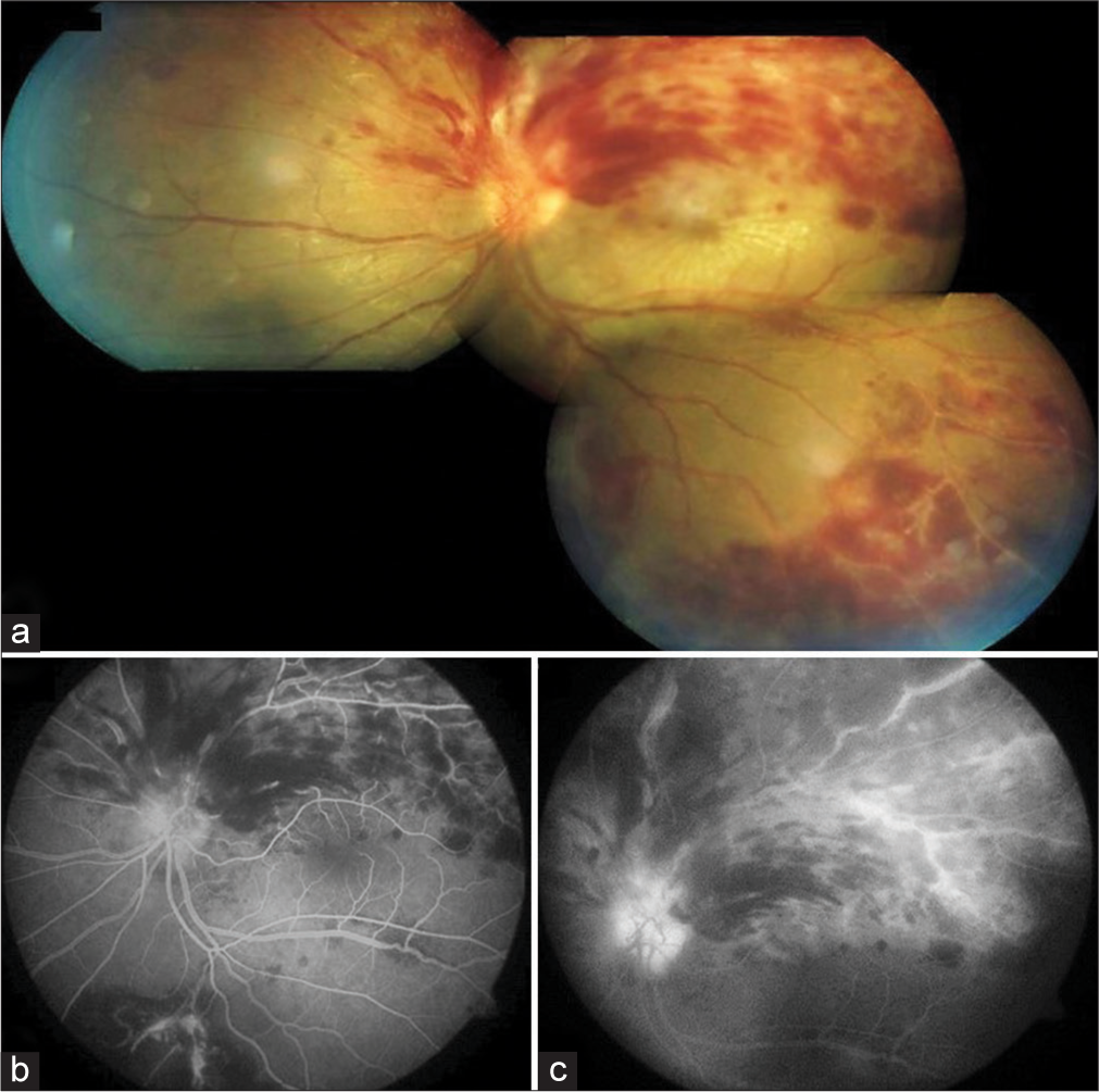 Peripheral occlusive retinal vasculitis and associated hemi-central retinal vein occlusion in the same eye with suspected neuroretinitis: A rare case report