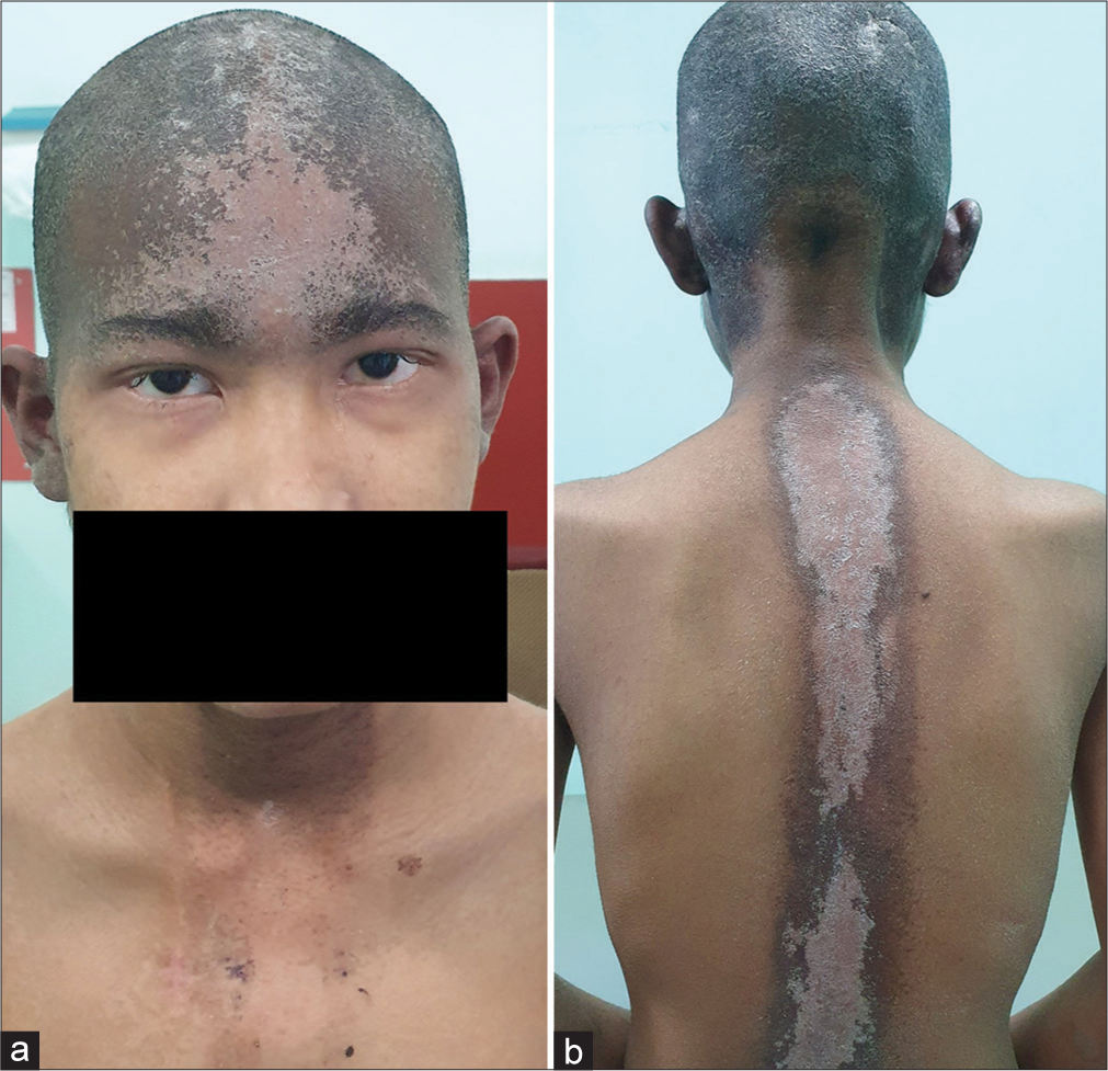 Craniospinal irradiation-induced dermatitis
