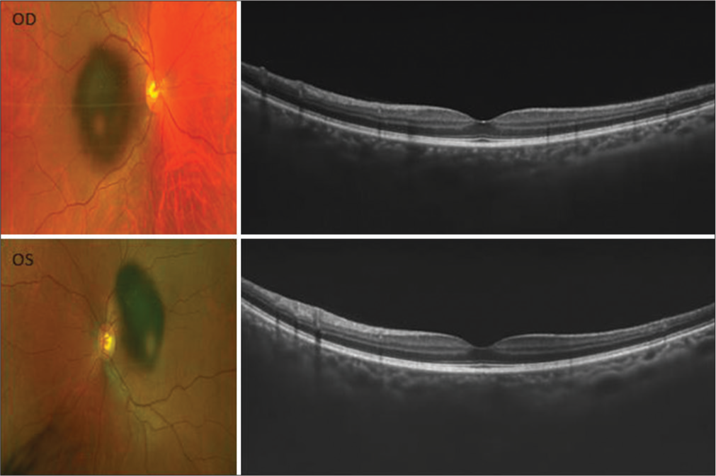 Visual field defects in neurocysticercosis: A rare presentation